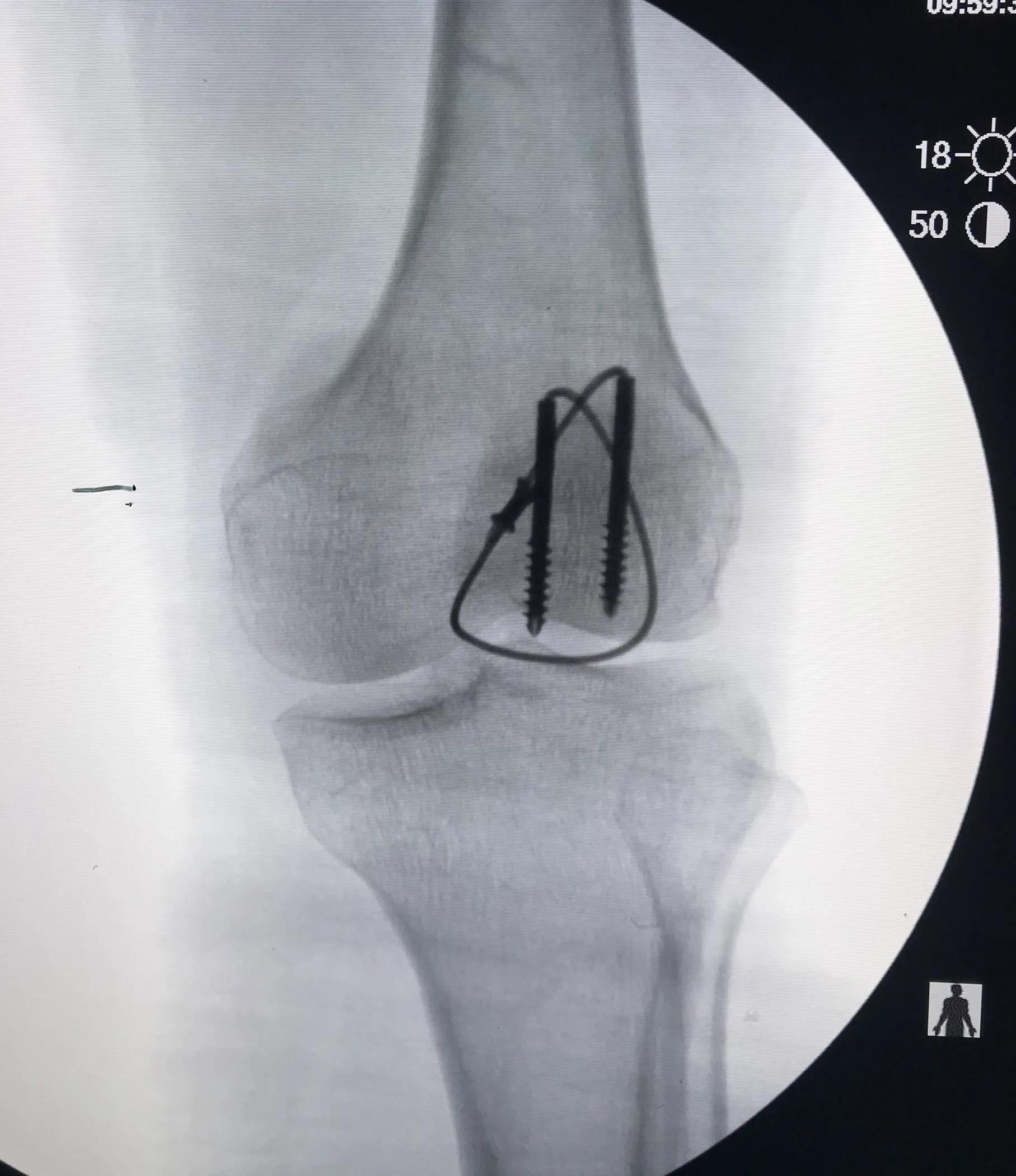 髌骨骨折的临床症状有哪些,髌骨骨折病因及发病机制