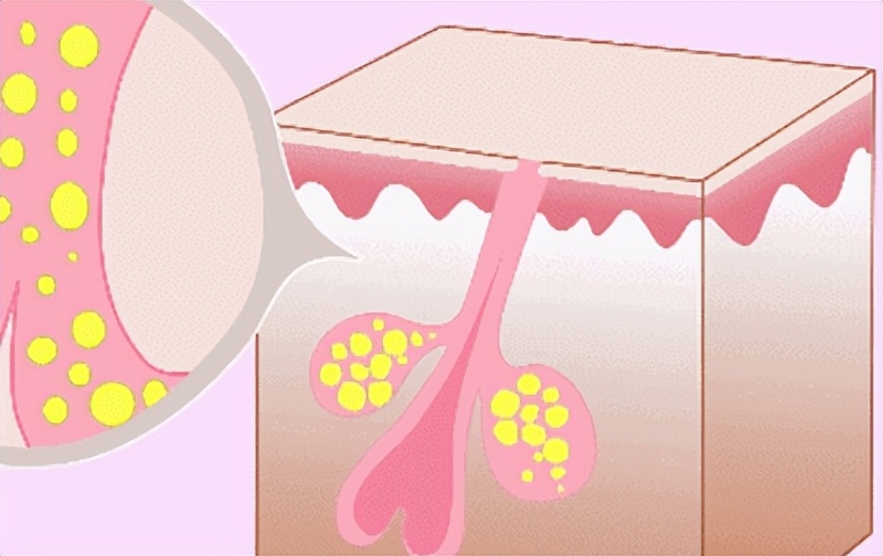 如何让毛孔缩小的方法,如何缩小毛孔最有效的方法