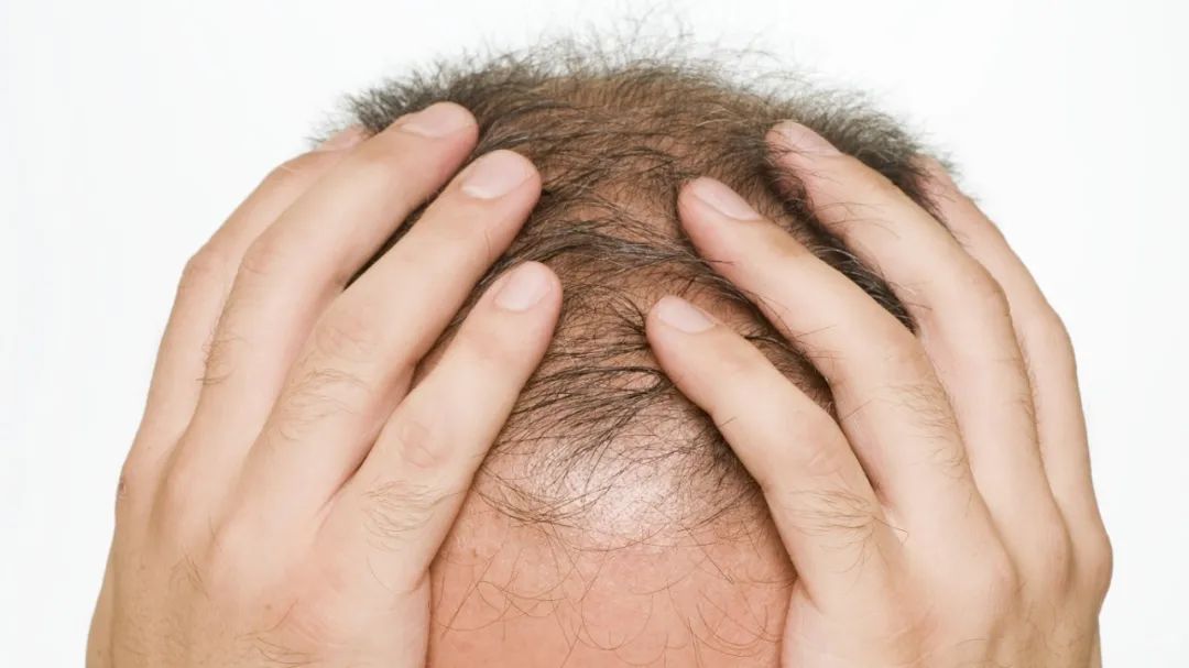 生姜擦头皮专治各种脱发视频,吃黑芝麻有什么好处治脱发吗