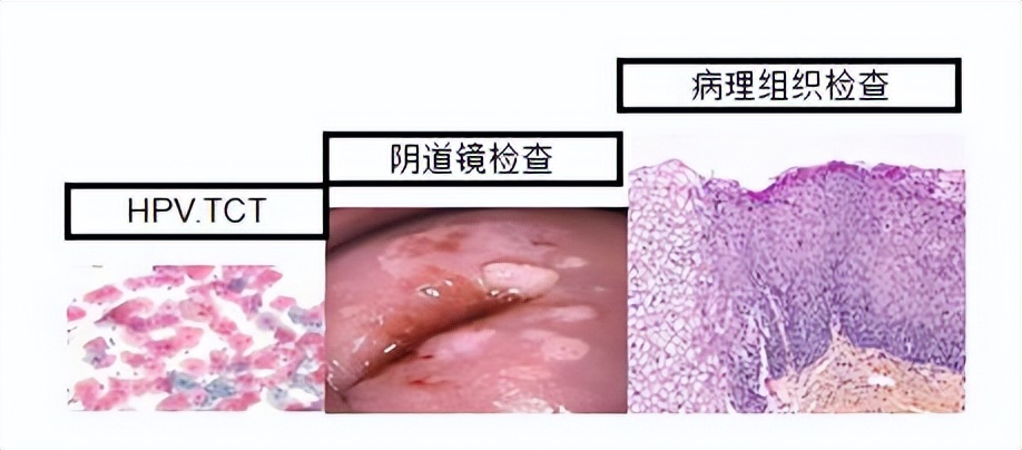 宫颈癌的4个常识,宫颈癌很可怕三个步骤教你预防