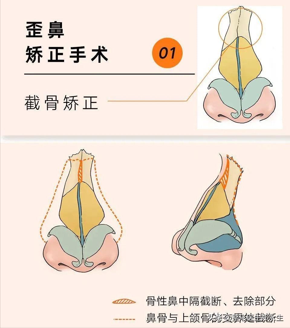 塌鼻和歪鼻如何处理,歪鼻原因