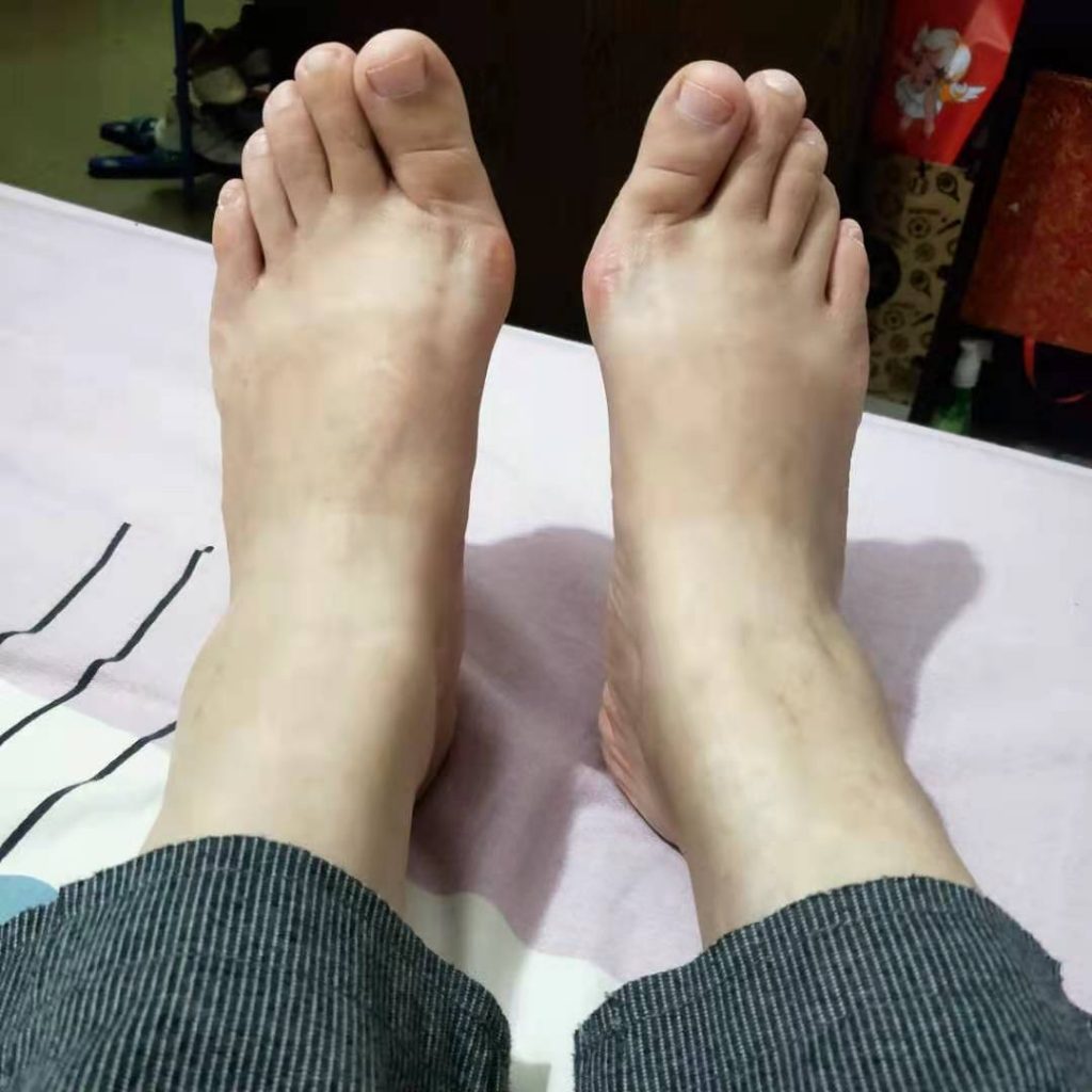 拇外翻怎么治疗呢,患了拇外翻怎么治疗比较好