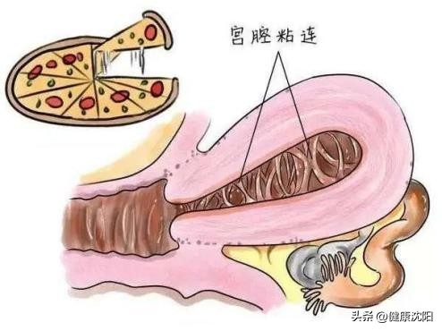 健康科普堂避孕,健康科普手术