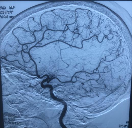 动脉瘤蛛网膜下腔出血术后并发症,动脉瘤导致蛛网膜下腔出血严重吗