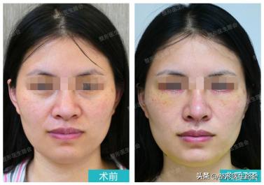 淡化泪沟有什么小技巧和方法,泪沟越来越明显是什么原因