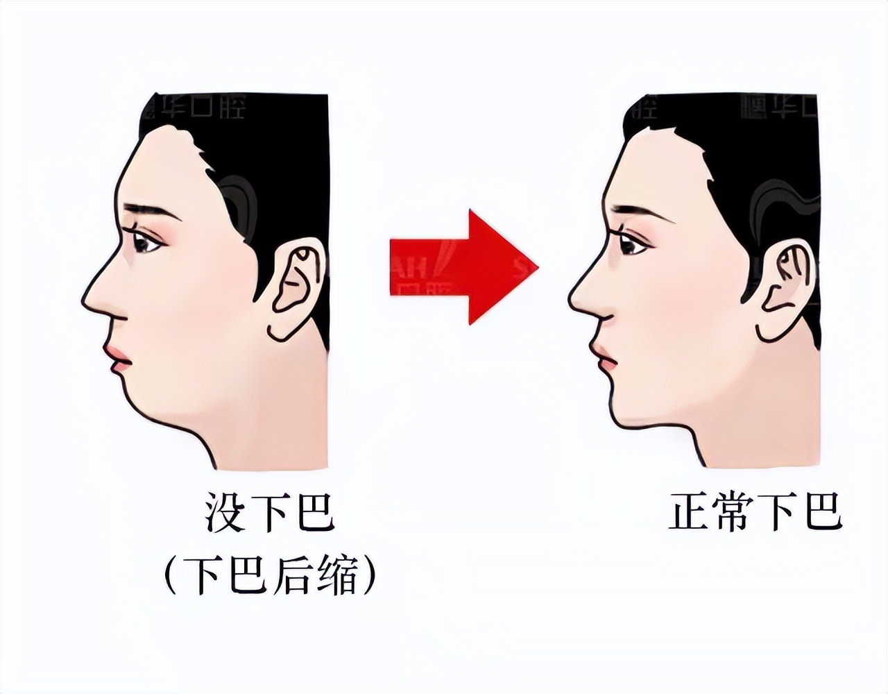 北大口腔医院儿童牙齿不齐矫正,儿童牙齿矫正北京大学口腔医院