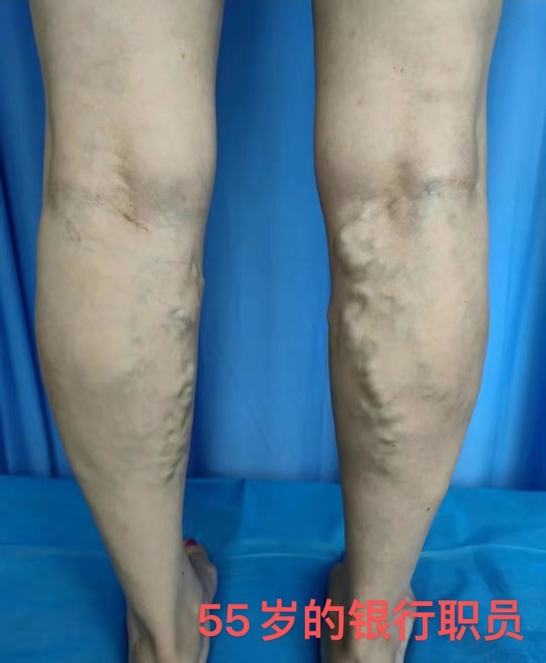 专家讲静脉曲张的治疗方法,静脉曲张临床诊治专家