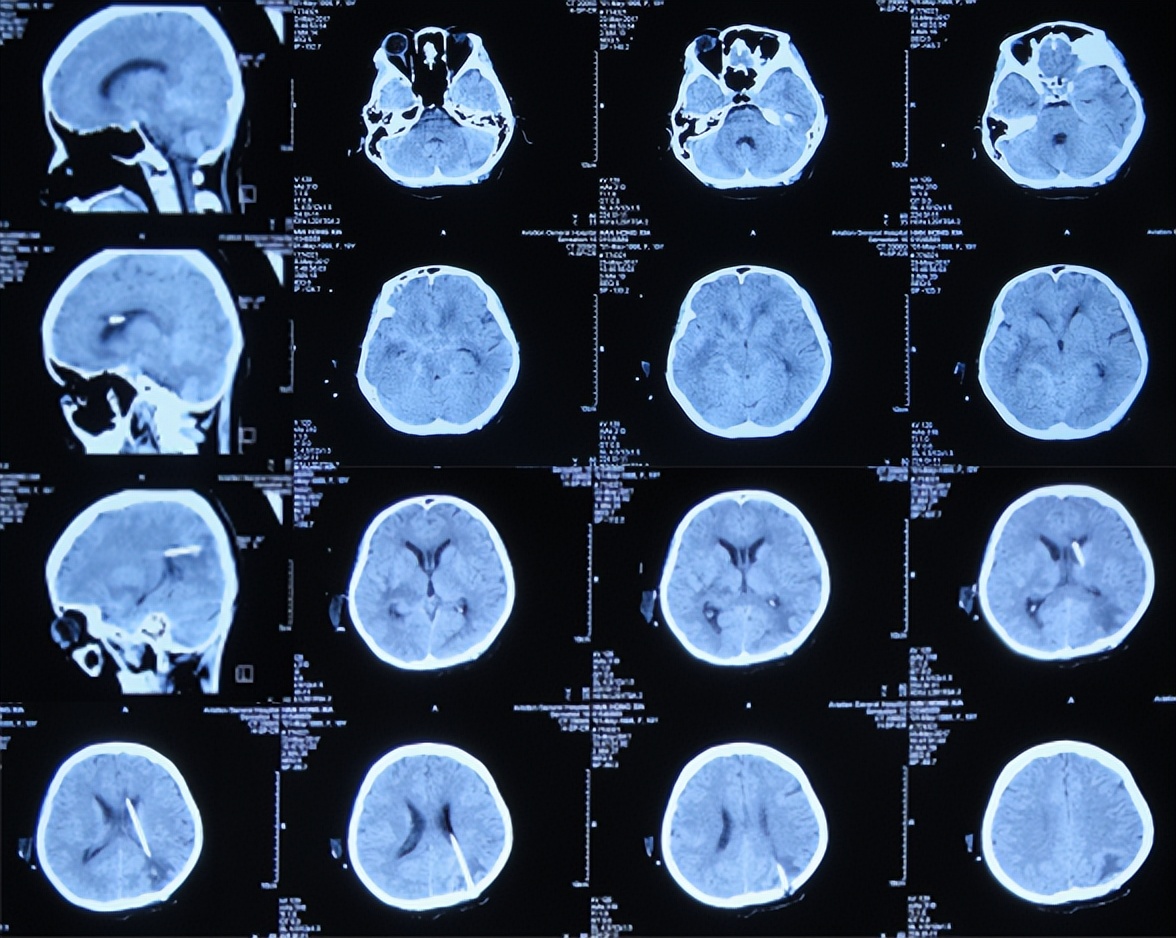 结核性脑积水能治愈吗,儿童结核脑膜炎脑积水