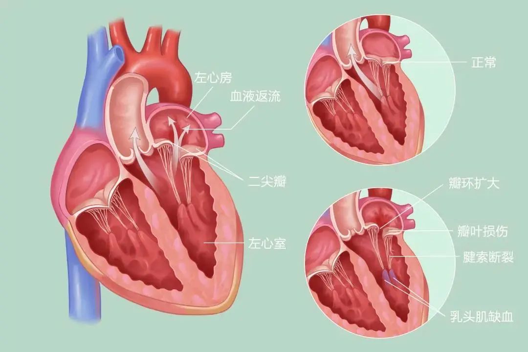 医生用小夹子为4名老人修好心门,76岁大爷心脏抢救