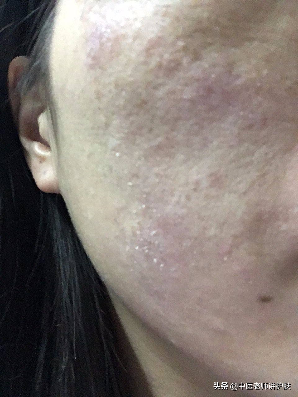 激素依赖性皮炎的发病机制,什么是激素依赖性皮炎怎么治疗