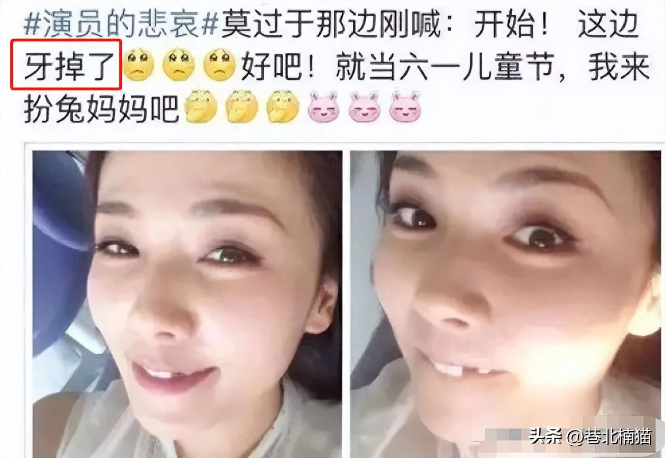 明星嘴突戴牙套前后对比,明星和假牙