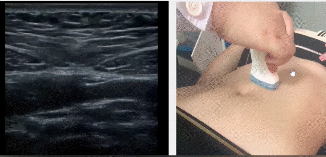 产后腹直肌恢复了肚子还突出,腹直肌分离肚子太松垮