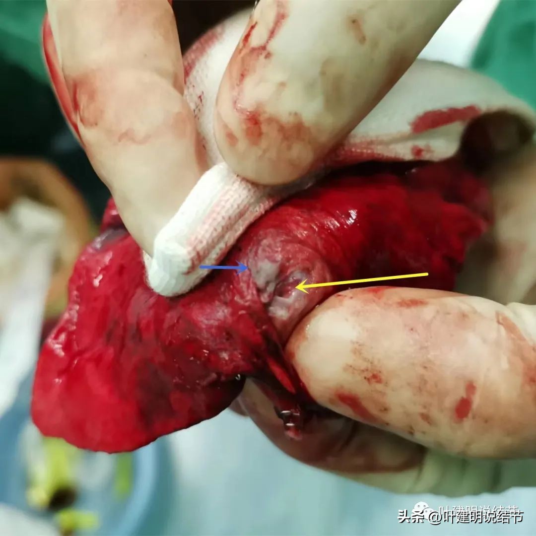 中叶多发微小结节,男性30岁右侧甲状腺单发结节