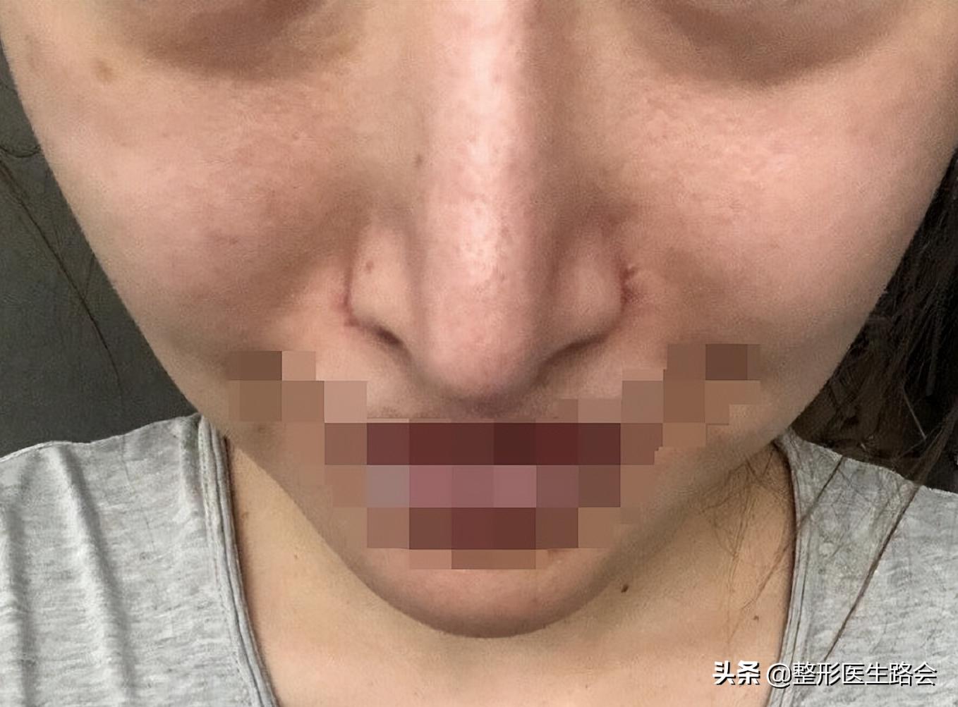 为什么隆鼻很久了鼻子还会歪,隆鼻了怎么确定鼻型歪不歪