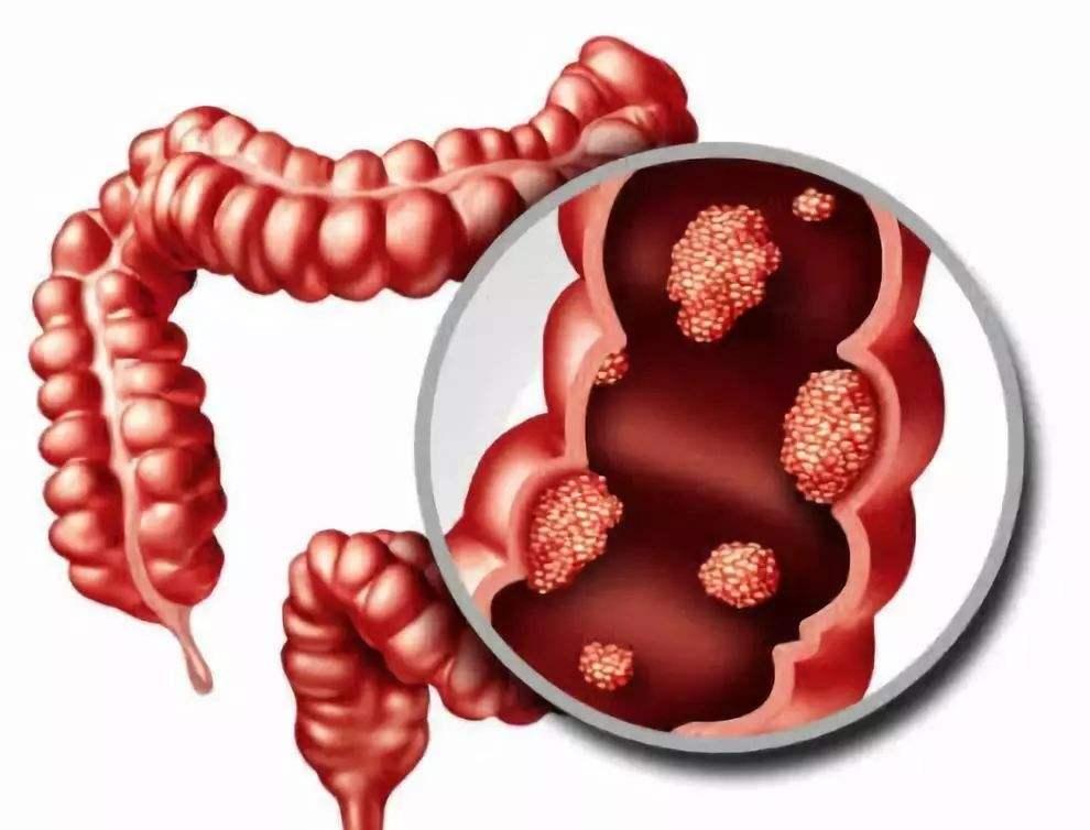 哪些症状要做肛门指检,身体发出这7种信号快去查癌