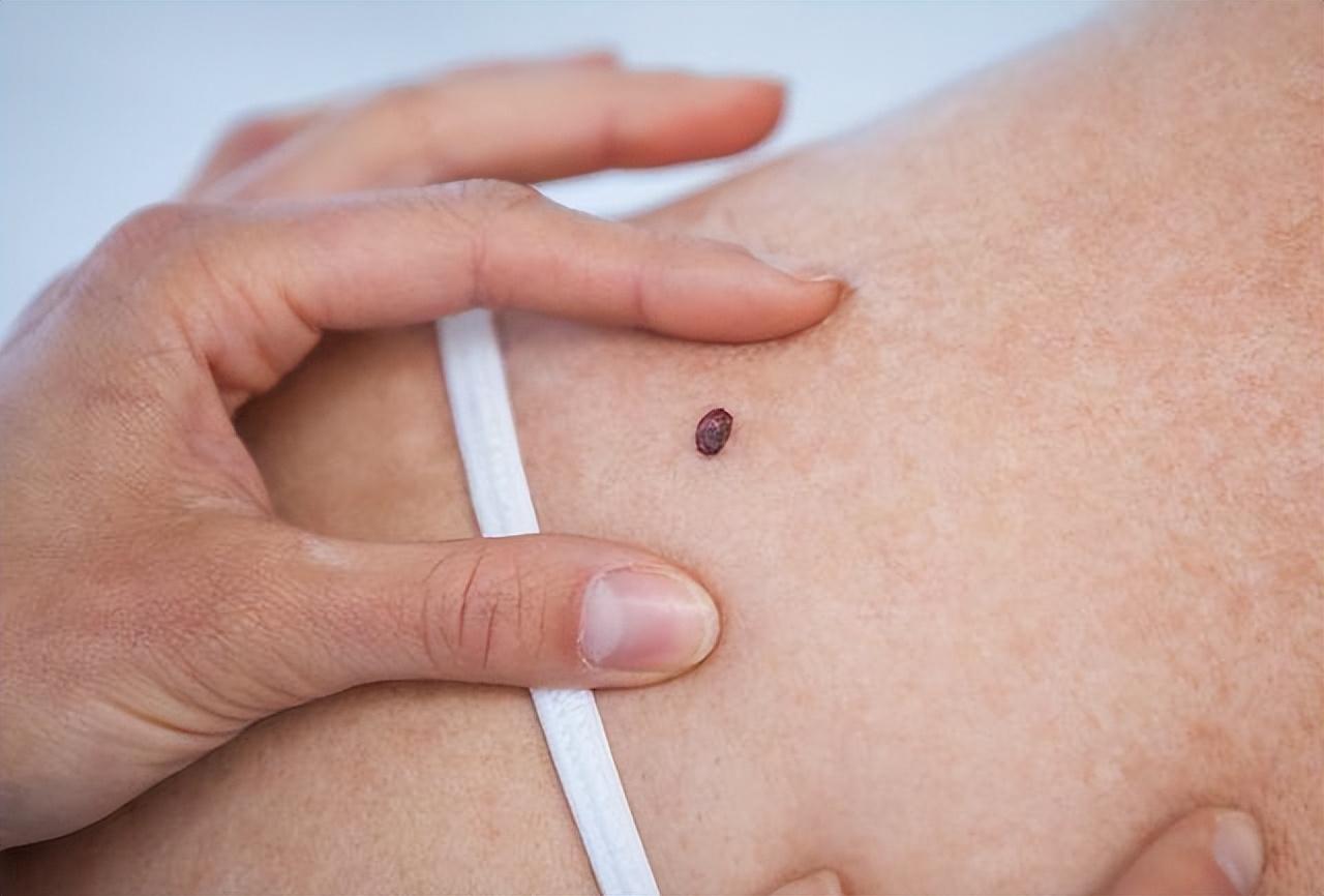 身上痣颜色很多种凸起怎么回事,黑痣长毛是好痣还是坏痣