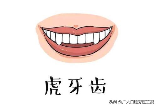 老虎牙矫正最快的方法,老虎牙矫正方法