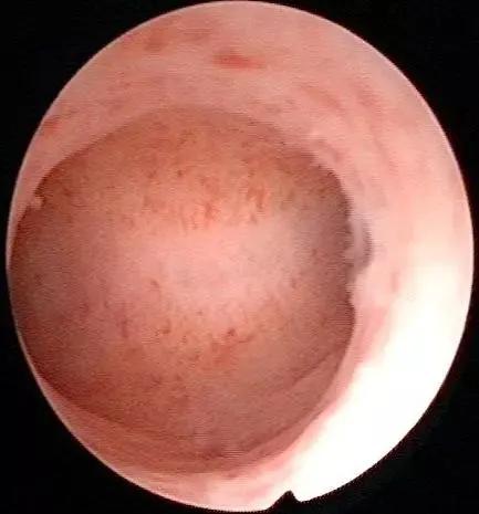 什么是宫腔镜？宫腔镜可以治疗哪些疾病？