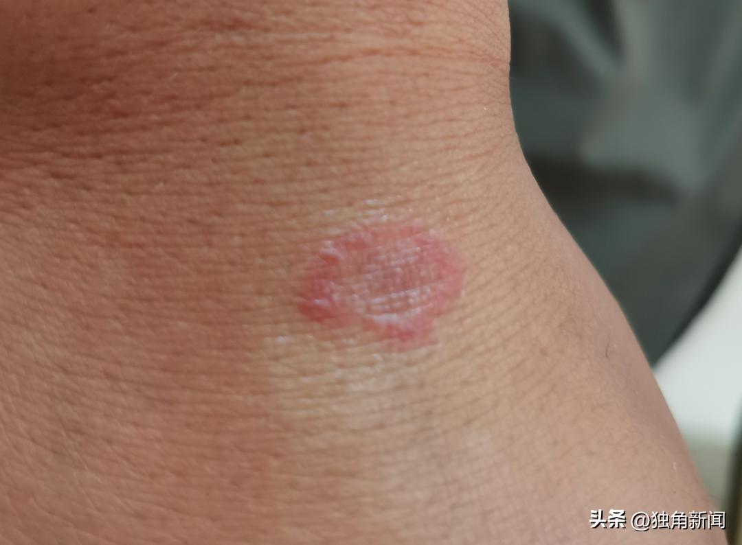 “吸猫撸狗”一时爽，小心皮肤“闹脾气”