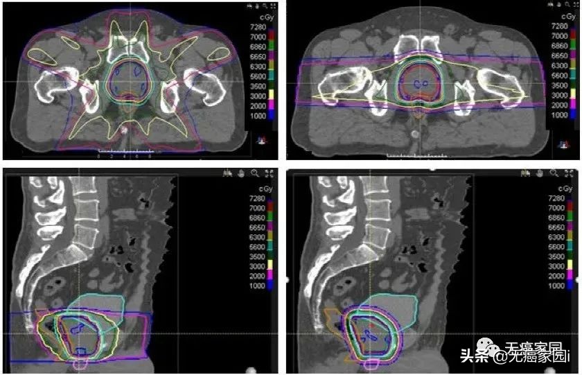 脑瘤、肺癌及儿童肿瘤等不妨考虑质子治疗,疗效和生存质量双保障