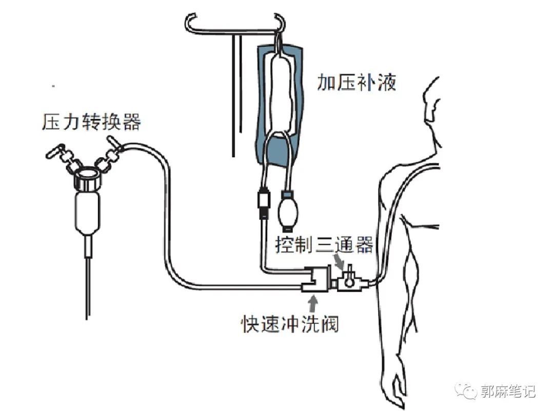 中心静脉穿刺置管术ppt免费,中心静脉置管的护理ppt