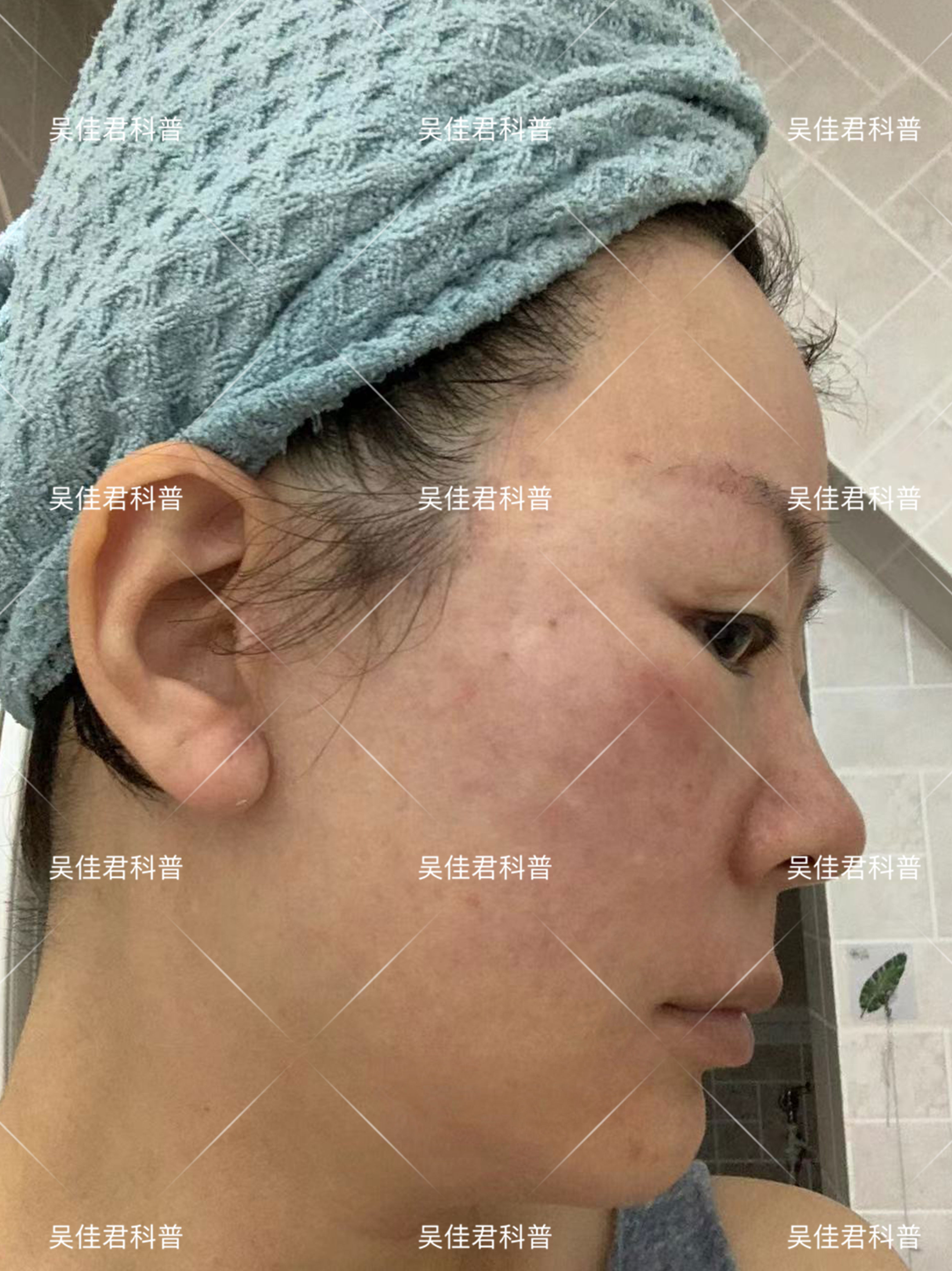 全脸皱纹拉皮手术对比,面部大拉皮恢复的真实感受