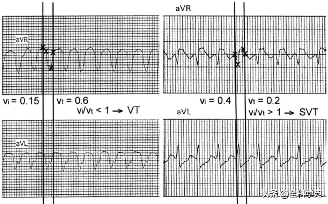 心电图上表现为宽qrs波,心电图中qrs是代表心动过速吗