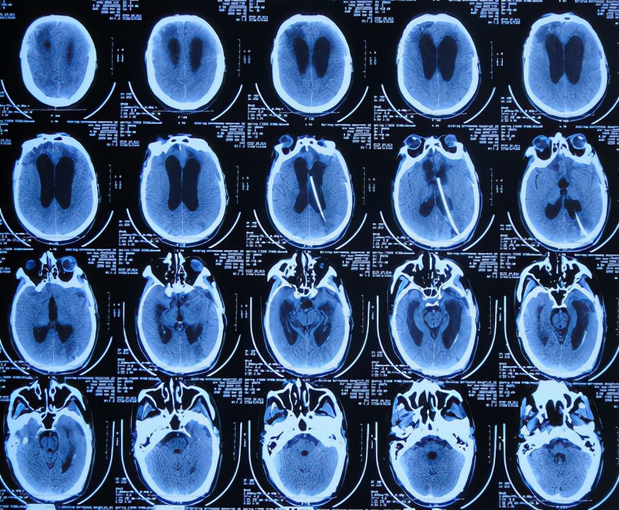 脑外伤后硬膜下积液颅骨修补,颅骨修复手术失败导致脑积水