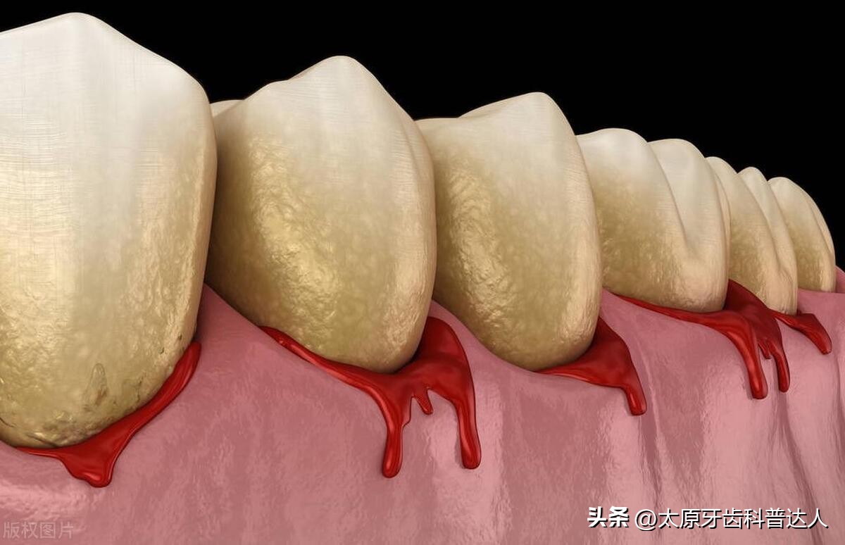 洗牙后的注意事项有哪些,做完洗牙喷砂后注意事项