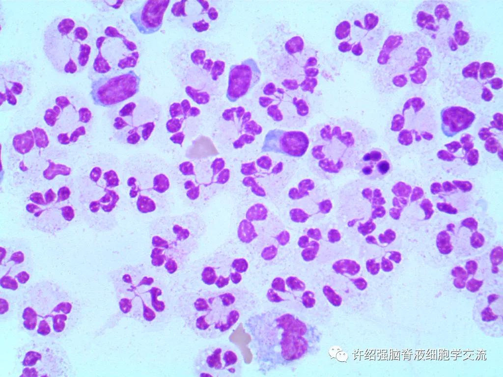 脑脊液脱落细胞学检查,脑脊液细胞学检查报告正常值多少