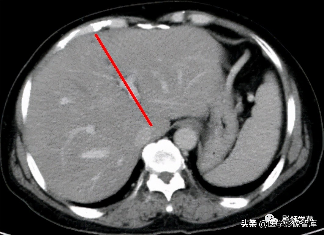 肝脏影像分叶分段解剖图,肝脏分段解剖图谱