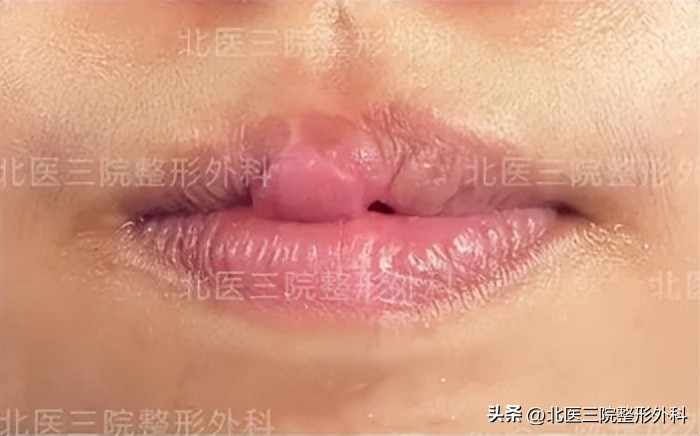 上嘴唇缺一块怎么修补,上嘴唇缺损