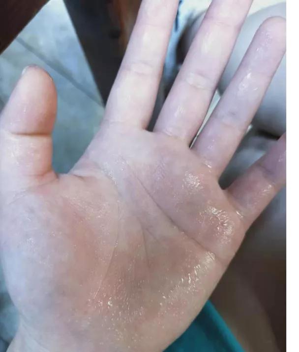 孩子从小手汗多是什么原因,儿童双手总出汗是怎么回事