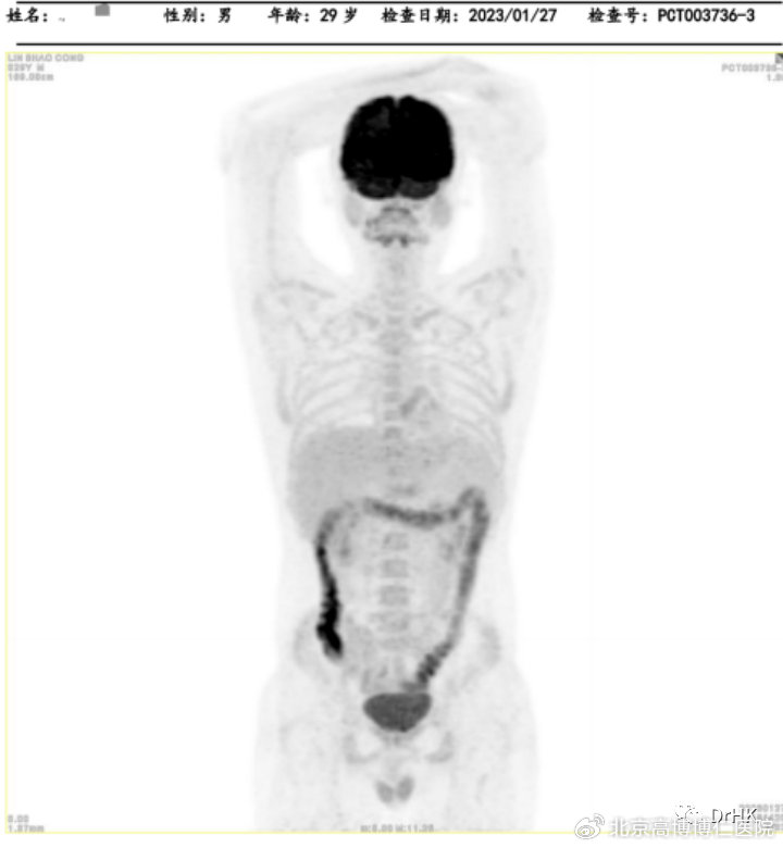 cart治疗淋巴瘤失败会怎样,car-t治疗晚期淋巴瘤的成功率