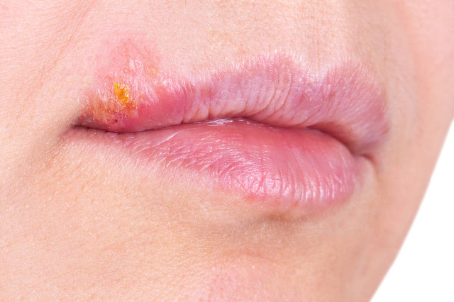 嘴巴长水泡一直不消,嘴巴上长水泡是上火吗