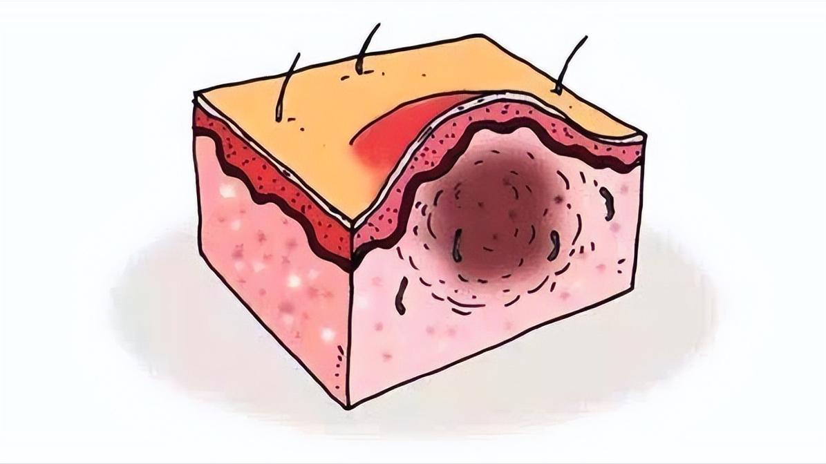 头皮上长红疙瘩脓包涂什么药膏,头皮上长红疙瘩脓包用什么药