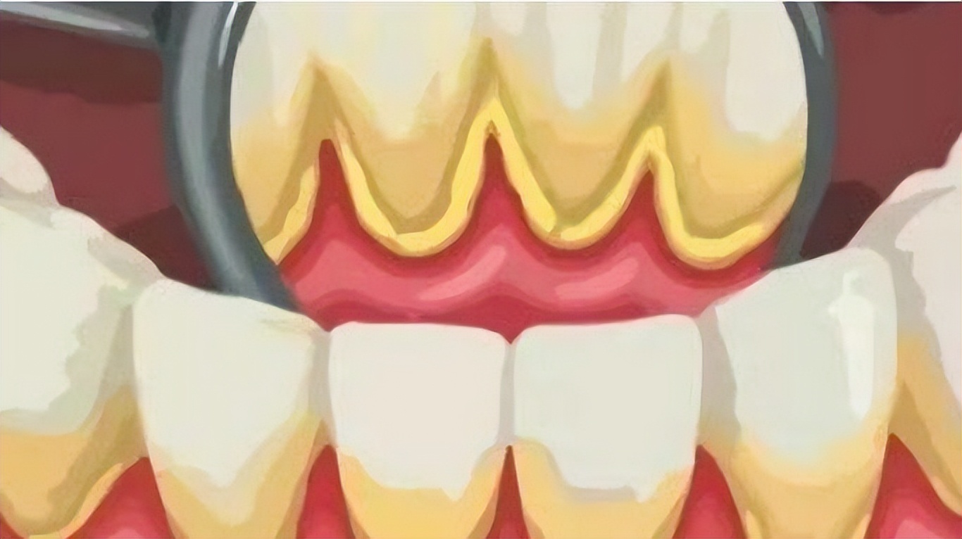 牙结石可以自己抠掉吗教你几招,牙结石自己可以抠掉吗教你小窍门