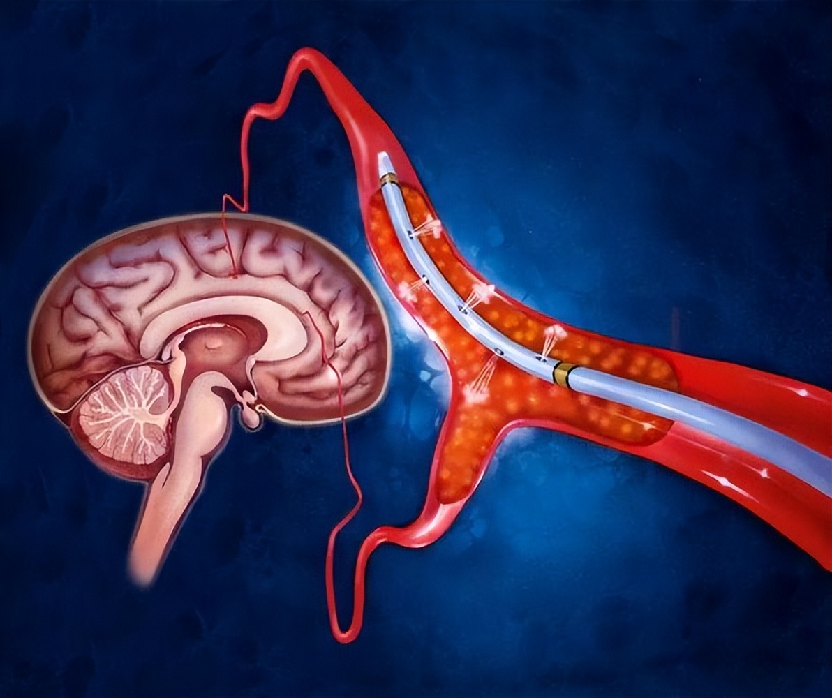 膝盖走路的时候会软一下,走路时膝盖突然闪痛并软了一下