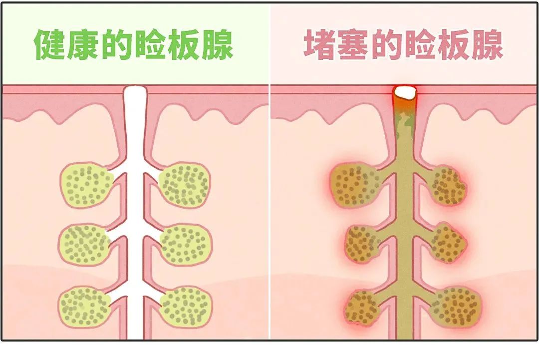眼干涩，眼疲劳，怎么办？两个小办法帮你缓解