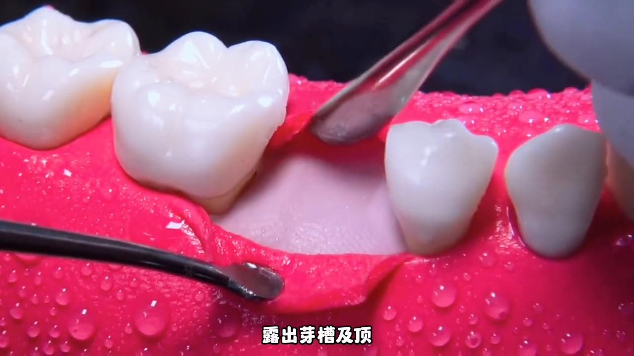 沉浸式牙处理,沉浸式弄牙齿