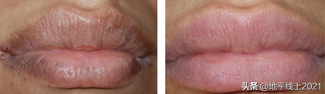 唇色深怎么办怎么变淡,唇色深怎么办四大技巧改善唇色深