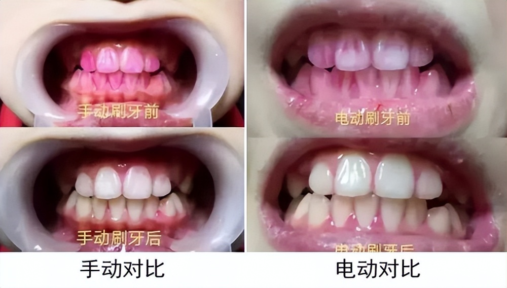 长期用电动牙刷对牙齿有伤害吗,电动牙刷和普通牙刷哪个对牙齿好
