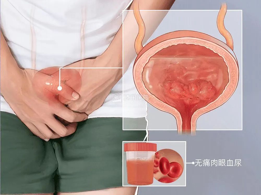 警惕血尿,女性突然无痛血尿一定是膀胱癌吗