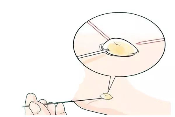 简述褥疮的预防和护理,褥疮起水泡怎么办