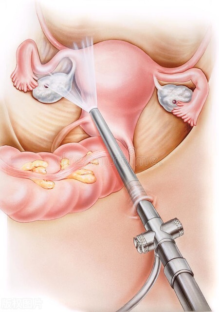夫妻生活后突然剧烈腹痛，原来是黄体破裂，紧急手术保住卵巢