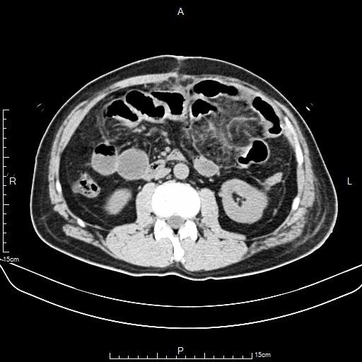非手术能治疗高位的肠梗阻吗,小肠梗阻的诊断