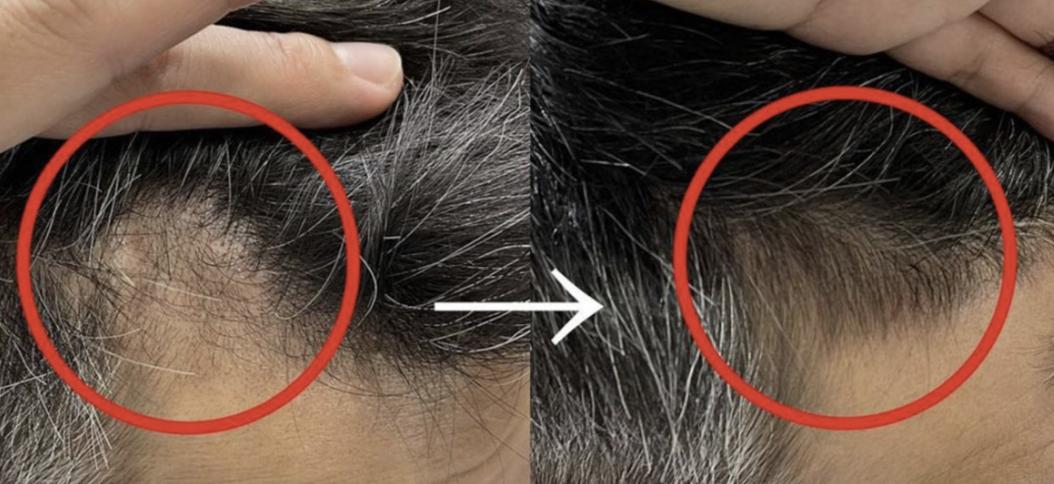 咋感觉越来越秃有没有生发小技巧 (20岁头发秃了通过药物可以生发吗)