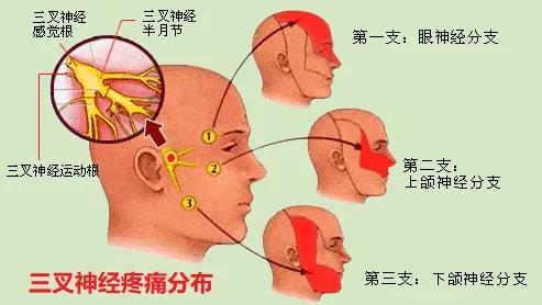 牙疼引起的三叉神经痛,三叉神经痛中医鉴别诊断