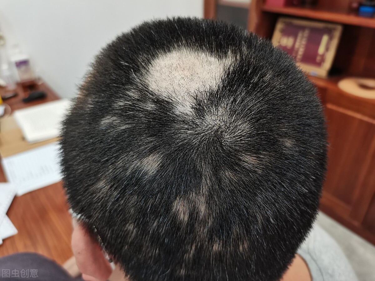 蒲公英治疗脱发和生发吗,蒲公英脱发