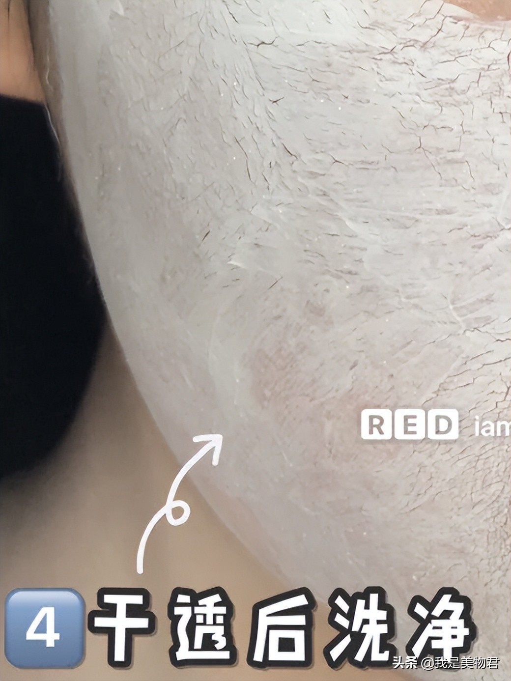 毛孔堵塞闭口粉刺怎么去除最有效,毛孔堵塞闭口粉刺怎么消除